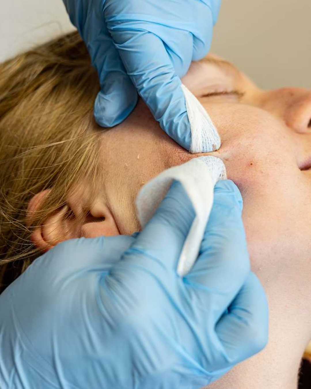 Acne behandeling
