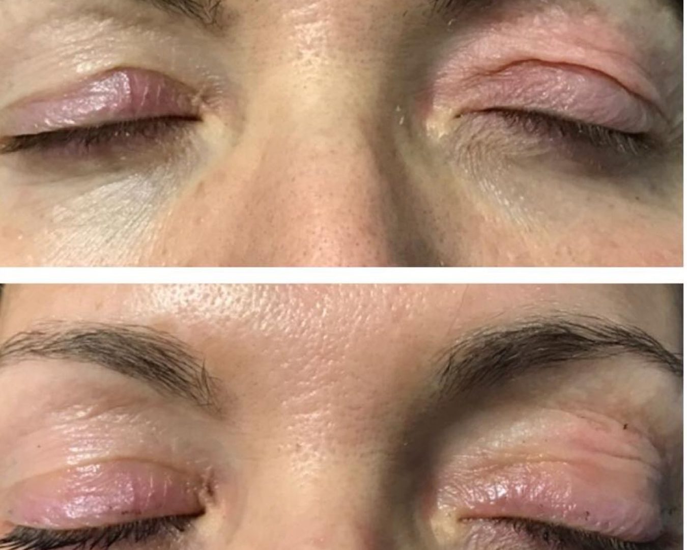 DAS-Plasma resultaat na 10 dagen - 1 sessie
